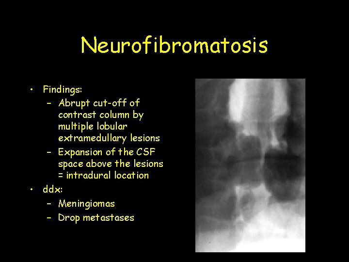 Neurofibromatosis • Findings: – Abrupt cut-off of contrast column by multiple lobular extramedullary lesions Neurofibromatosis • Findings: – Abrupt cut-off of contrast column by multiple lobular extramedullary lesions