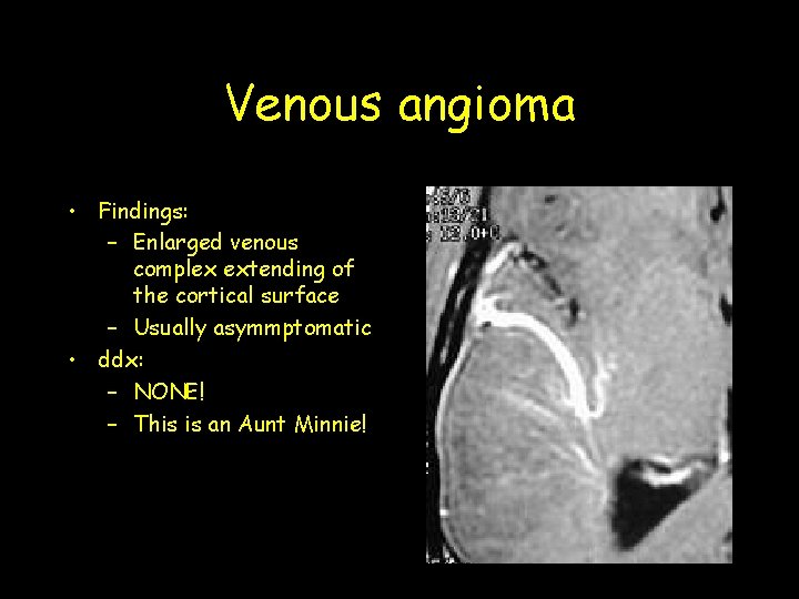Venous angioma • Findings: – Enlarged venous complex extending of the cortical surface – Venous angioma • Findings: – Enlarged venous complex extending of the cortical surface –