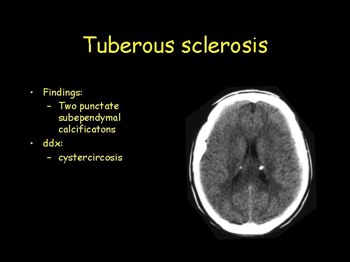 Tuberous sclerosis • Findings: – Two punctate subependymal calcificatons • ddx: – cystercircosis Tuberous sclerosis • Findings: – Two punctate subependymal calcificatons • ddx: – cystercircosis