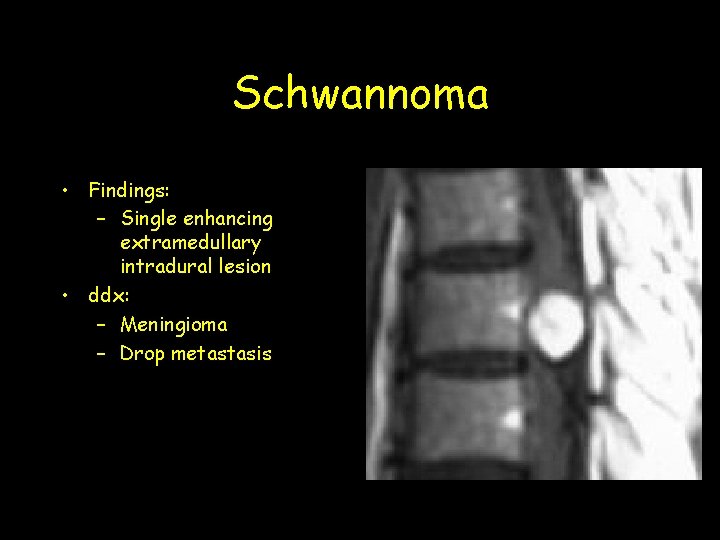 Schwannoma • Findings: – Single enhancing extramedullary intradural lesion • ddx: – Meningioma – Schwannoma • Findings: – Single enhancing extramedullary intradural lesion • ddx: – Meningioma –