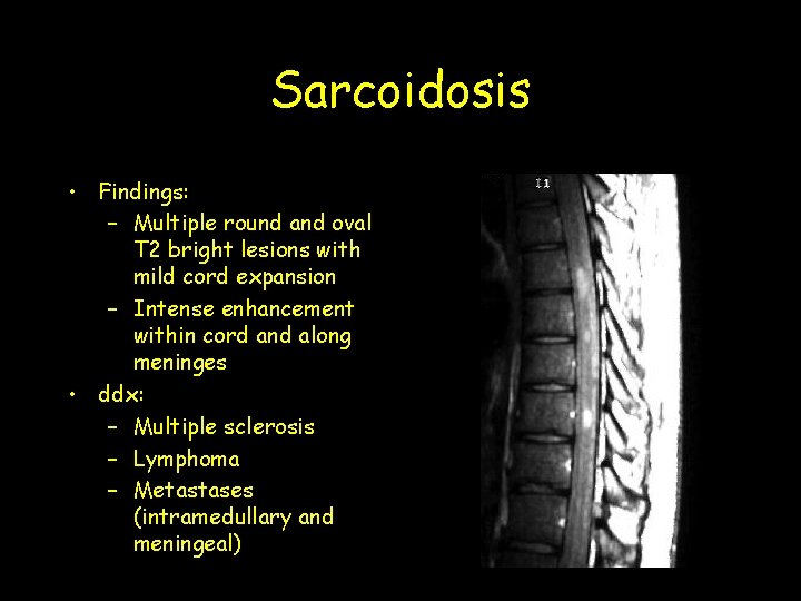 Sarcoidosis • Findings: – Multiple round and oval T 2 bright lesions with mild Sarcoidosis • Findings: – Multiple round and oval T 2 bright lesions with mild