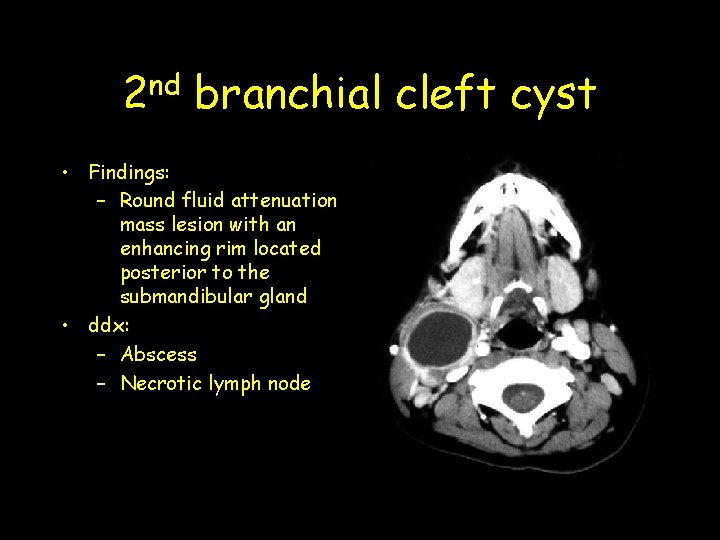 nd 2 branchial cleft cyst • Findings: – Round fluid attenuation mass lesion with nd 2 branchial cleft cyst • Findings: – Round fluid attenuation mass lesion with