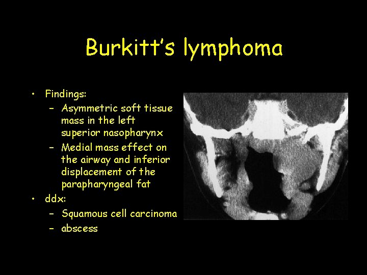 Burkitt’s lymphoma • Findings: – Asymmetric soft tissue mass in the left superior nasopharynx Burkitt’s lymphoma • Findings: – Asymmetric soft tissue mass in the left superior nasopharynx