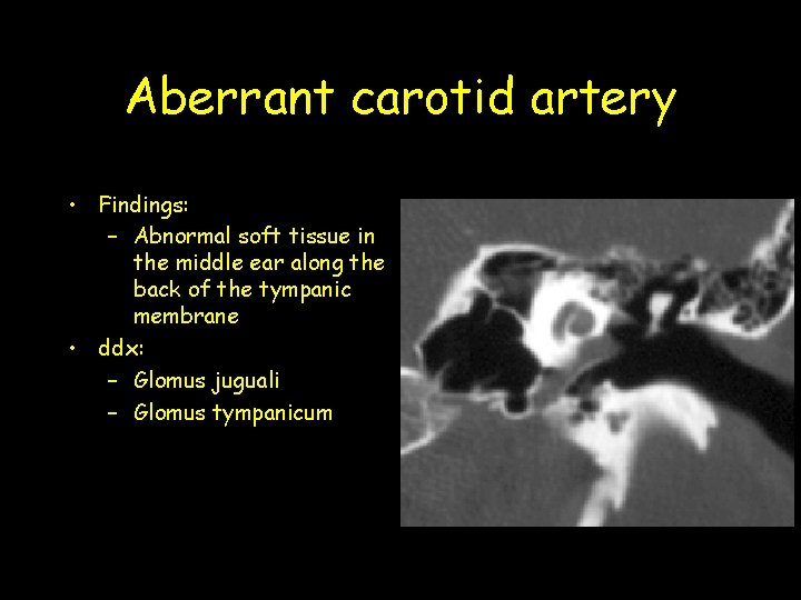 Aberrant carotid artery • Findings: – Abnormal soft tissue in the middle ear along Aberrant carotid artery • Findings: – Abnormal soft tissue in the middle ear along