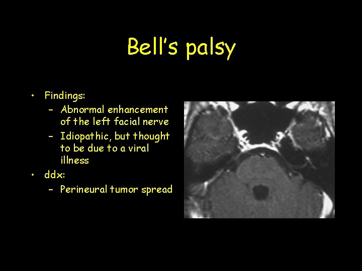 Bell’s palsy • Findings: – Abnormal enhancement of the left facial nerve – Idiopathic, Bell’s palsy • Findings: – Abnormal enhancement of the left facial nerve – Idiopathic,