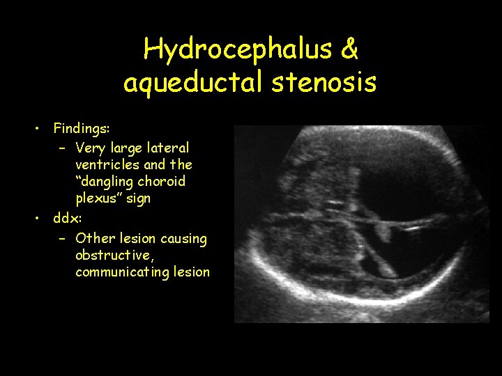 Hydrocephalus & aqueductal stenosis • Findings: – Very large lateral ventricles and the “dangling Hydrocephalus & aqueductal stenosis • Findings: – Very large lateral ventricles and the “dangling