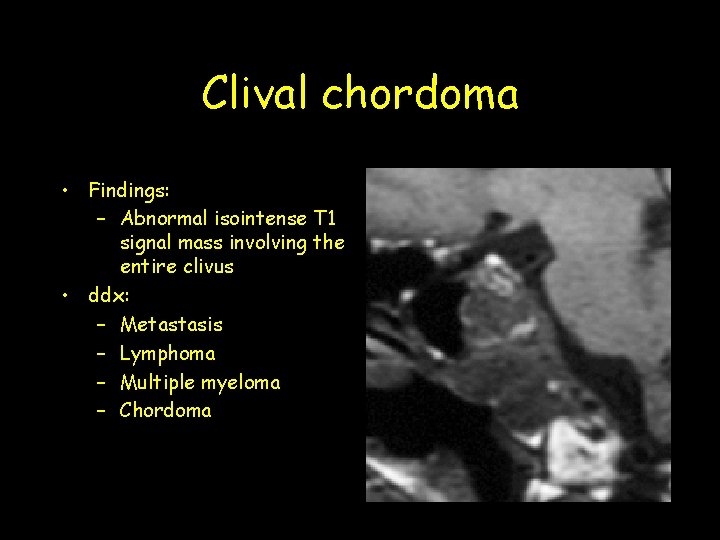 Clival chordoma • Findings: – Abnormal isointense T 1 signal mass involving the entire Clival chordoma • Findings: – Abnormal isointense T 1 signal mass involving the entire