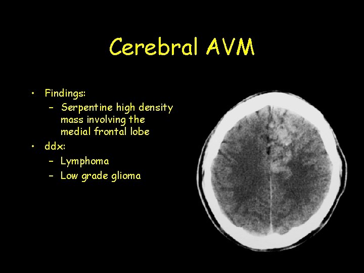 Cerebral AVM • Findings: – Serpentine high density mass involving the medial frontal lobe Cerebral AVM • Findings: – Serpentine high density mass involving the medial frontal lobe