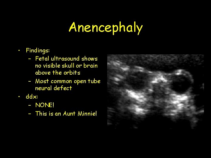 Anencephaly • Findings: – Fetal ultrasound shows no visible skull or brain above the Anencephaly • Findings: – Fetal ultrasound shows no visible skull or brain above the