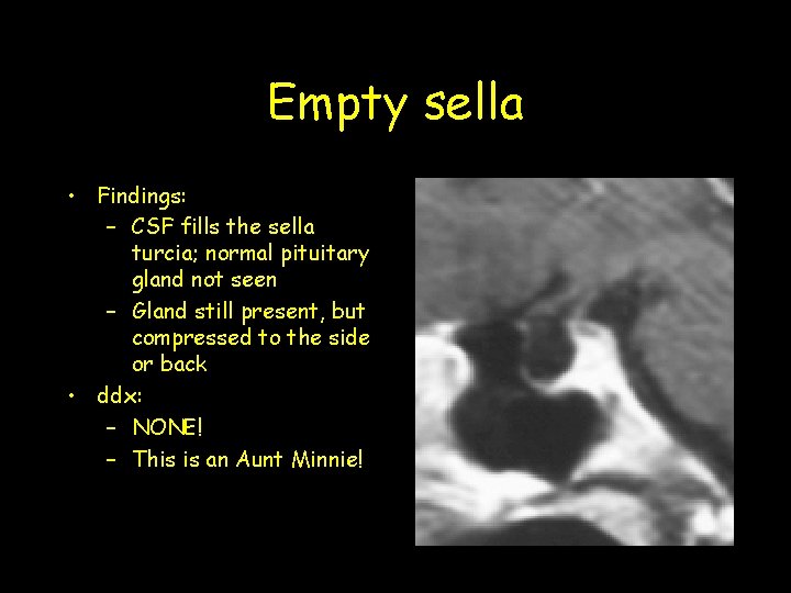 Empty sella • Findings: – CSF fills the sella turcia; normal pituitary gland not Empty sella • Findings: – CSF fills the sella turcia; normal pituitary gland not
