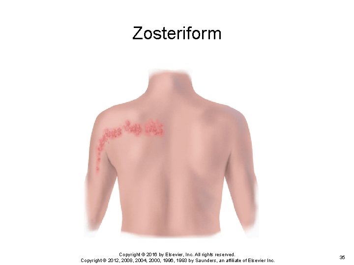Zosteriform Copyright © 2016 by Elsevier, Inc. All rights reserved. Copyright © 2012, 2008, Zosteriform Copyright © 2016 by Elsevier, Inc. All rights reserved. Copyright © 2012, 2008,