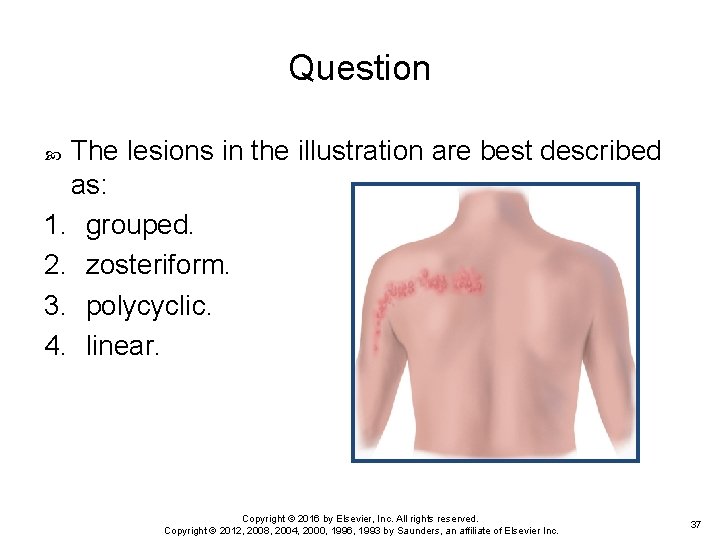 Question The lesions in the illustration are best described as: 1. grouped. 2. zosteriform. Question The lesions in the illustration are best described as: 1. grouped. 2. zosteriform.