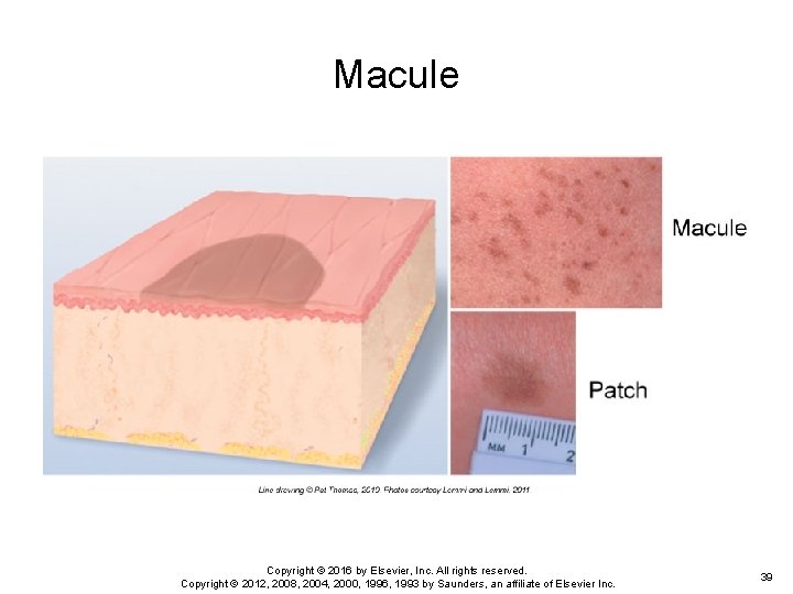Macule Copyright © 2016 by Elsevier, Inc. All rights reserved. Copyright © 2012, 2008, Macule Copyright © 2016 by Elsevier, Inc. All rights reserved. Copyright © 2012, 2008,