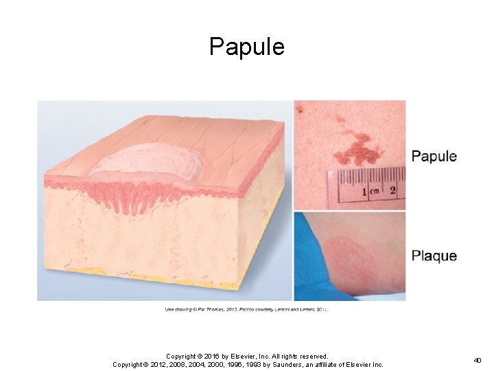 Papule Copyright © 2016 by Elsevier, Inc. All rights reserved. Copyright © 2012, 2008, Papule Copyright © 2016 by Elsevier, Inc. All rights reserved. Copyright © 2012, 2008,