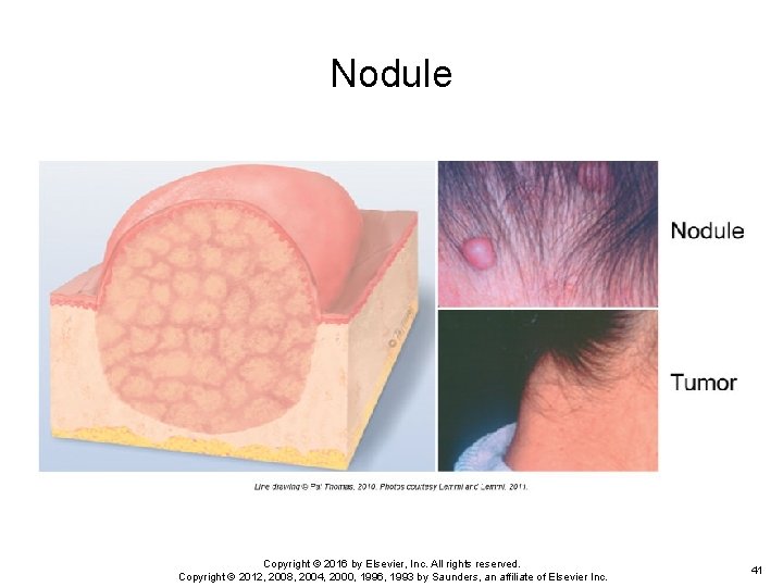 Nodule Copyright © 2016 by Elsevier, Inc. All rights reserved. Copyright © 2012, 2008, Nodule Copyright © 2016 by Elsevier, Inc. All rights reserved. Copyright © 2012, 2008,