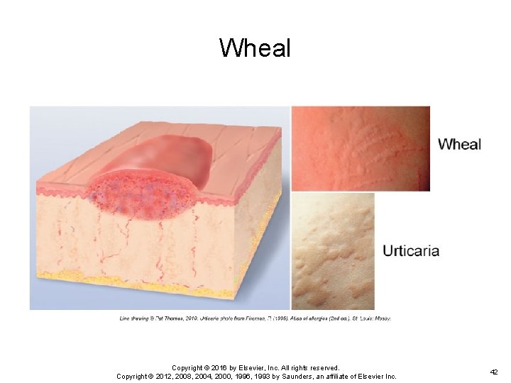 Wheal Copyright © 2016 by Elsevier, Inc. All rights reserved. Copyright © 2012, 2008, Wheal Copyright © 2016 by Elsevier, Inc. All rights reserved. Copyright © 2012, 2008,