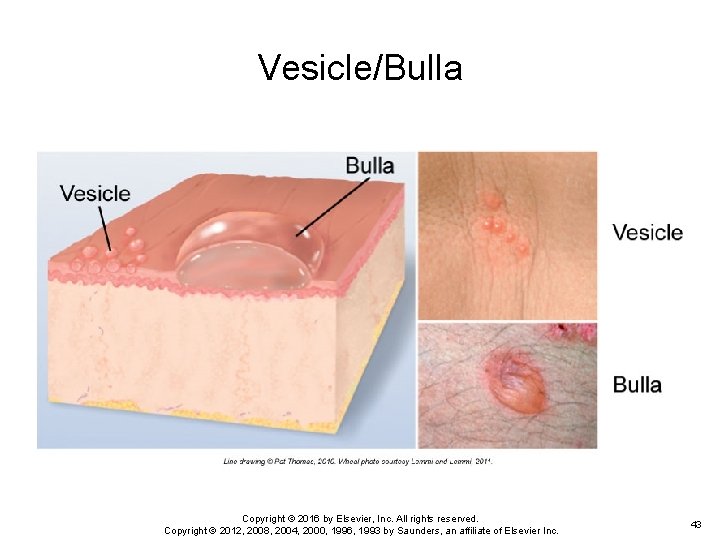 Vesicle/Bulla Copyright © 2016 by Elsevier, Inc. All rights reserved. Copyright © 2012, 2008, Vesicle/Bulla Copyright © 2016 by Elsevier, Inc. All rights reserved. Copyright © 2012, 2008,