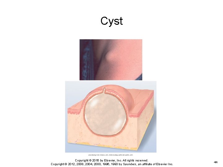 Cyst Copyright © 2016 by Elsevier, Inc. All rights reserved. Copyright © 2012, 2008, Cyst Copyright © 2016 by Elsevier, Inc. All rights reserved. Copyright © 2012, 2008,