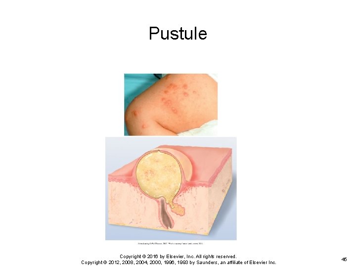 Pustule Copyright © 2016 by Elsevier, Inc. All rights reserved. Copyright © 2012, 2008, Pustule Copyright © 2016 by Elsevier, Inc. All rights reserved. Copyright © 2012, 2008,