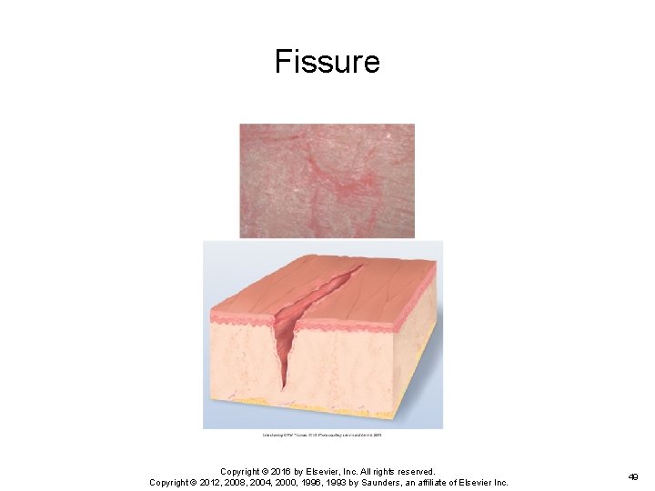 Fissure Copyright © 2016 by Elsevier, Inc. All rights reserved. Copyright © 2012, 2008, Fissure Copyright © 2016 by Elsevier, Inc. All rights reserved. Copyright © 2012, 2008,