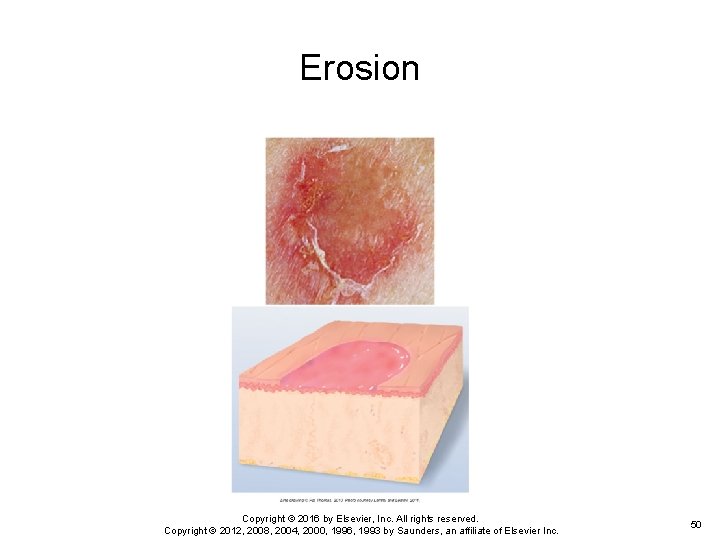 Erosion Copyright © 2016 by Elsevier, Inc. All rights reserved. Copyright © 2012, 2008, Erosion Copyright © 2016 by Elsevier, Inc. All rights reserved. Copyright © 2012, 2008,