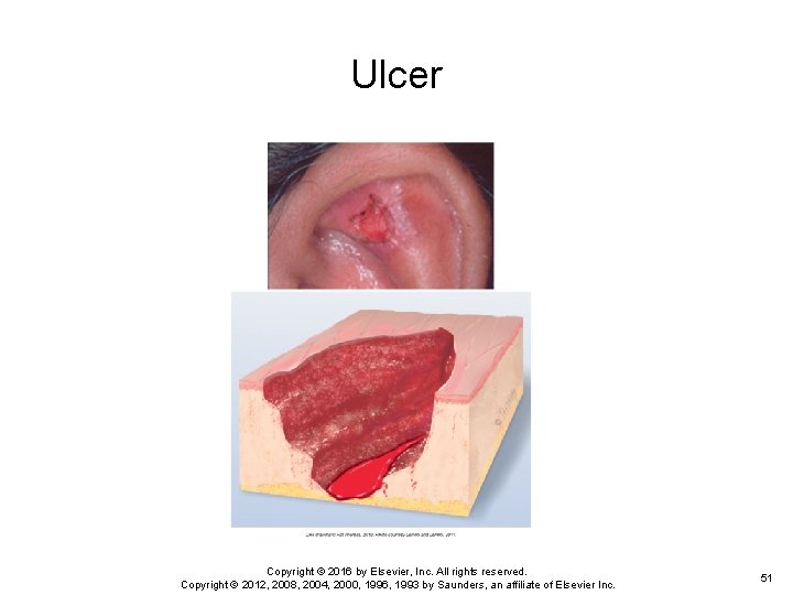 Ulcer Copyright © 2016 by Elsevier, Inc. All rights reserved. Copyright © 2012, 2008, Ulcer Copyright © 2016 by Elsevier, Inc. All rights reserved. Copyright © 2012, 2008,