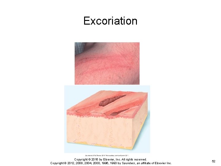 Excoriation Copyright © 2016 by Elsevier, Inc. All rights reserved. Copyright © 2012, 2008, Excoriation Copyright © 2016 by Elsevier, Inc. All rights reserved. Copyright © 2012, 2008,