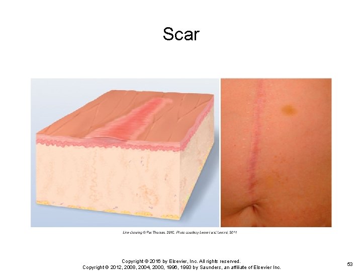 Scar Copyright © 2016 by Elsevier, Inc. All rights reserved. Copyright © 2012, 2008, Scar Copyright © 2016 by Elsevier, Inc. All rights reserved. Copyright © 2012, 2008,