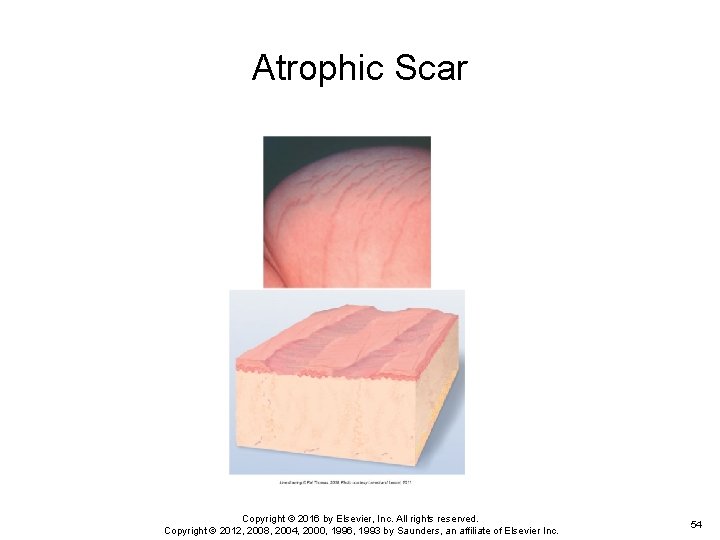 Atrophic Scar Copyright © 2016 by Elsevier, Inc. All rights reserved. Copyright © 2012, Atrophic Scar Copyright © 2016 by Elsevier, Inc. All rights reserved. Copyright © 2012,