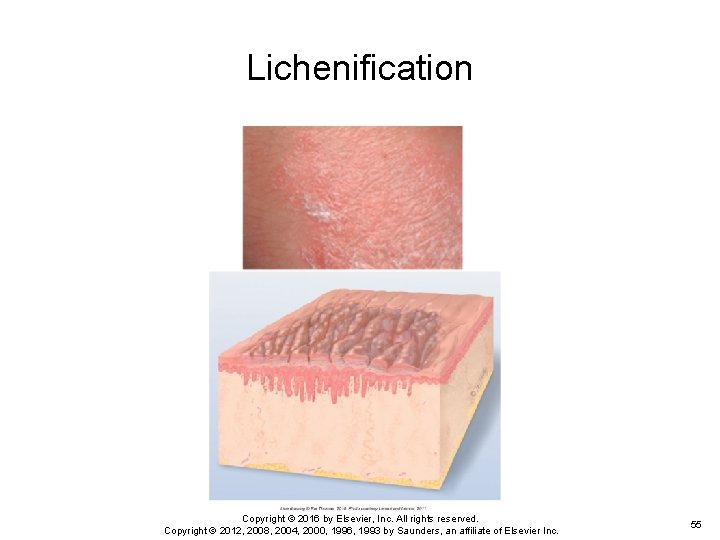 Lichenification Copyright © 2016 by Elsevier, Inc. All rights reserved. Copyright © 2012, 2008, Lichenification Copyright © 2016 by Elsevier, Inc. All rights reserved. Copyright © 2012, 2008,