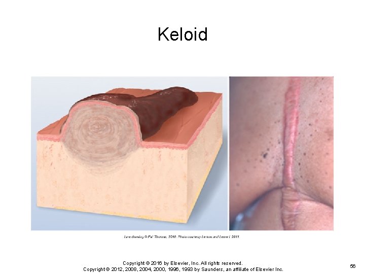 Keloid Copyright © 2016 by Elsevier, Inc. All rights reserved. Copyright © 2012, 2008, Keloid Copyright © 2016 by Elsevier, Inc. All rights reserved. Copyright © 2012, 2008,
