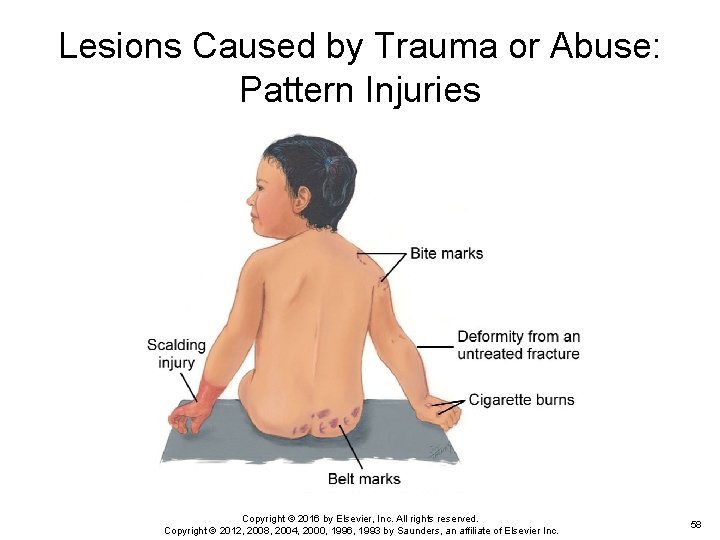 Lesions Caused by Trauma or Abuse: Pattern Injuries Copyright © 2016 by Elsevier, Inc. Lesions Caused by Trauma or Abuse: Pattern Injuries Copyright © 2016 by Elsevier, Inc.
