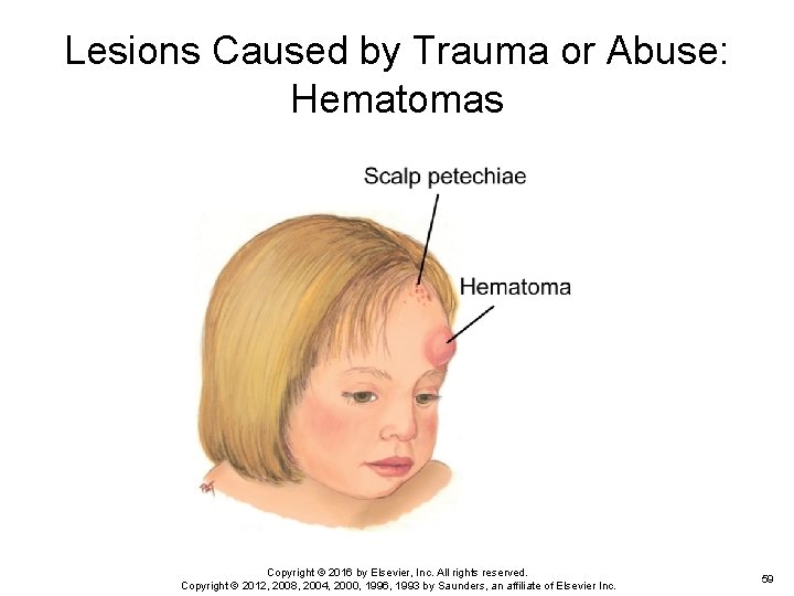 Lesions Caused by Trauma or Abuse: Hematomas Copyright © 2016 by Elsevier, Inc. All Lesions Caused by Trauma or Abuse: Hematomas Copyright © 2016 by Elsevier, Inc. All