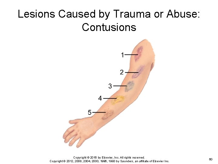 Lesions Caused by Trauma or Abuse: Contusions Copyright © 2016 by Elsevier, Inc. All Lesions Caused by Trauma or Abuse: Contusions Copyright © 2016 by Elsevier, Inc. All