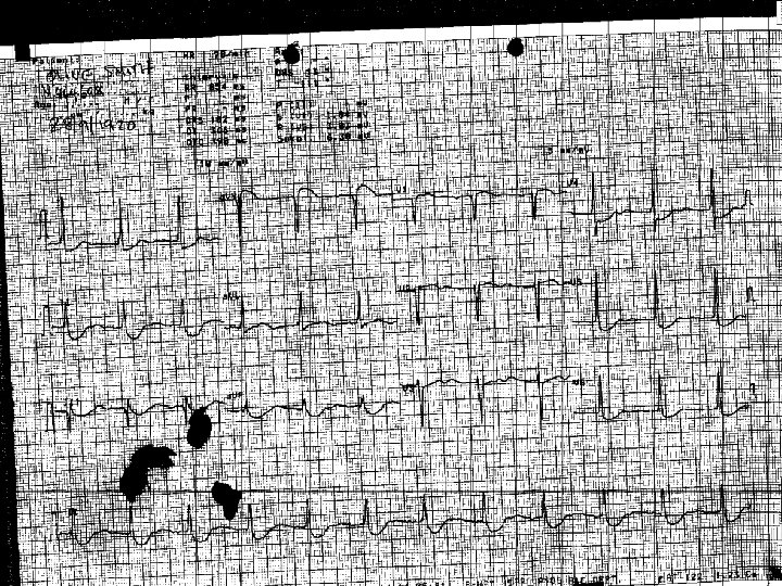 Case 2 Seen by Cardiac ANP – ‘unlikely STEMI ? falls due to chronic