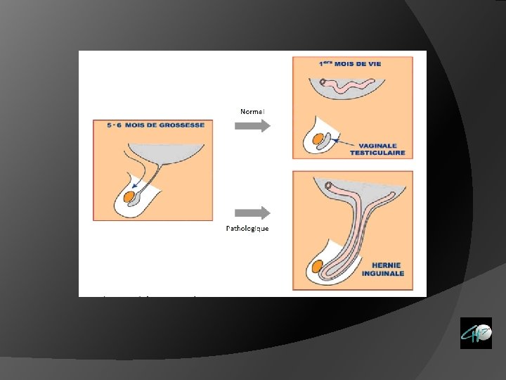 Particularit S Des Hernies De Laine Chez Hernie