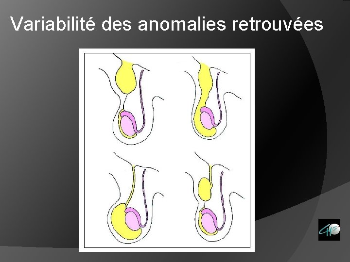 Variabilité des anomalies retrouvées 