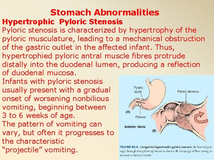 Stomach Abnormalities Hypertrophic Pyloric Stenosis Pyloric stenosis is characterized by hypertrophy of the pyloric