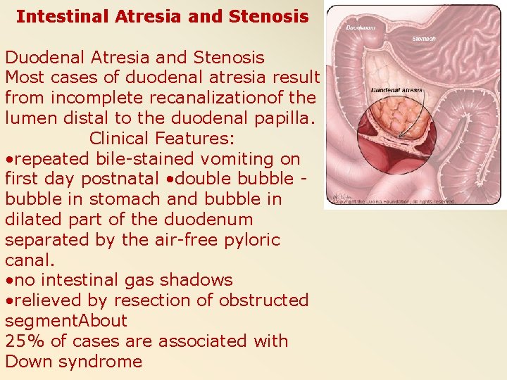 Intestinal Atresia and Stenosis Duodenal Atresia and Stenosis Most cases of duodenal atresia result