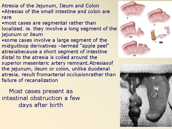 Atresia of the Jejunum, Ileum and Colon • Atresias of the small intestine and