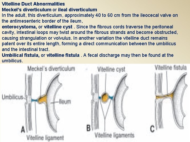 Vitelline Duct Abnormalities Meckel’s diverticulum or ileal diverticulum In the adult, this diverticulum, approximately