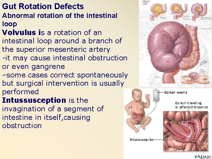 Gut Rotation Defects Abnormal rotation of the intestinal loop Volvulus is a rotation of