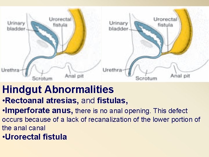 Hindgut Abnormalities • Rectoanal atresias, and fistulas, • Imperforate anus, there is no anal