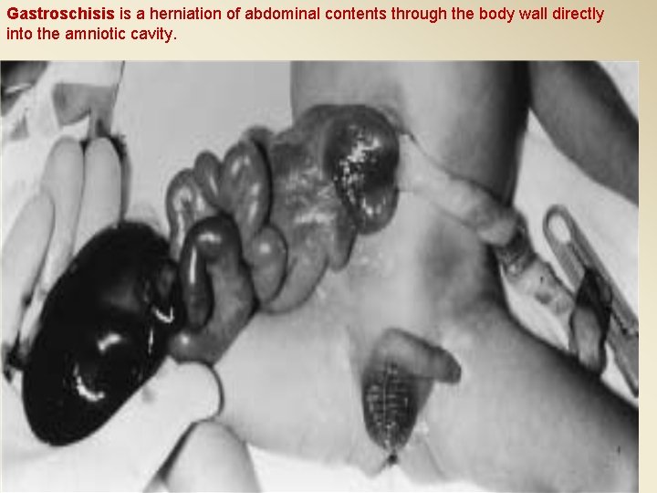 Gastroschisis is a herniation of abdominal contents through the body wall directly into the