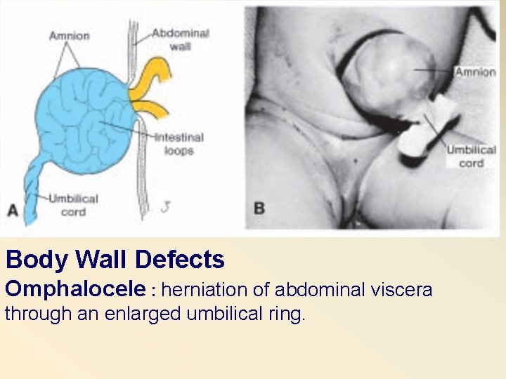 Body Wall Defects Omphalocele : herniation of abdominal viscera through an enlarged umbilical ring.