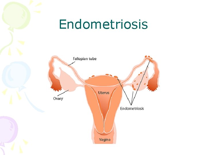 Endometriosis 