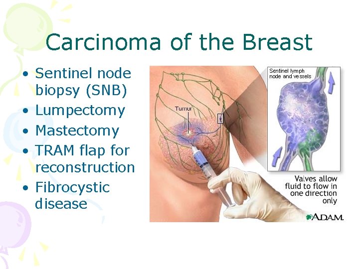 Carcinoma of the Breast • Sentinel node biopsy (SNB) • Lumpectomy • Mastectomy •
