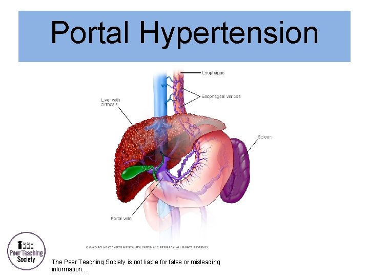 Portal Hypertension The Peer Teaching Society is not liable for false or misleading information…