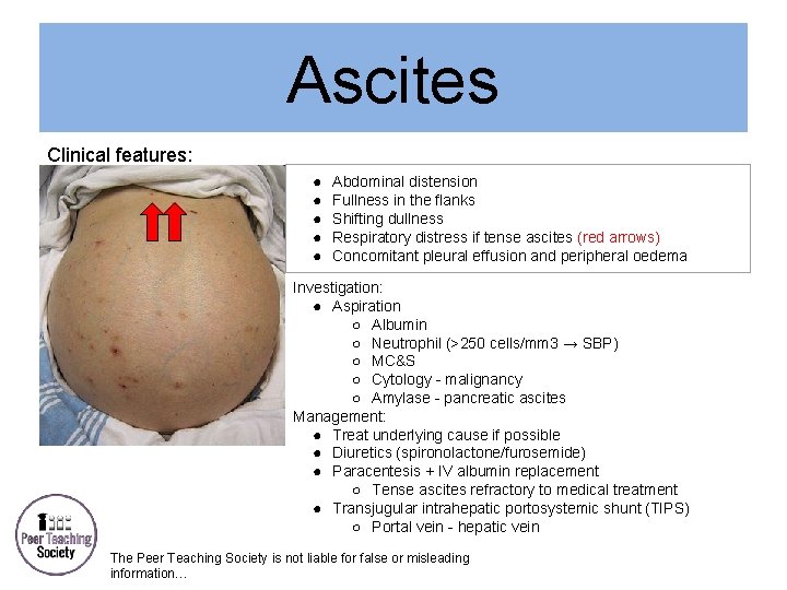 Ascites Clinical features: ● ● ● Abdominal distension Fullness in the flanks Shifting dullness