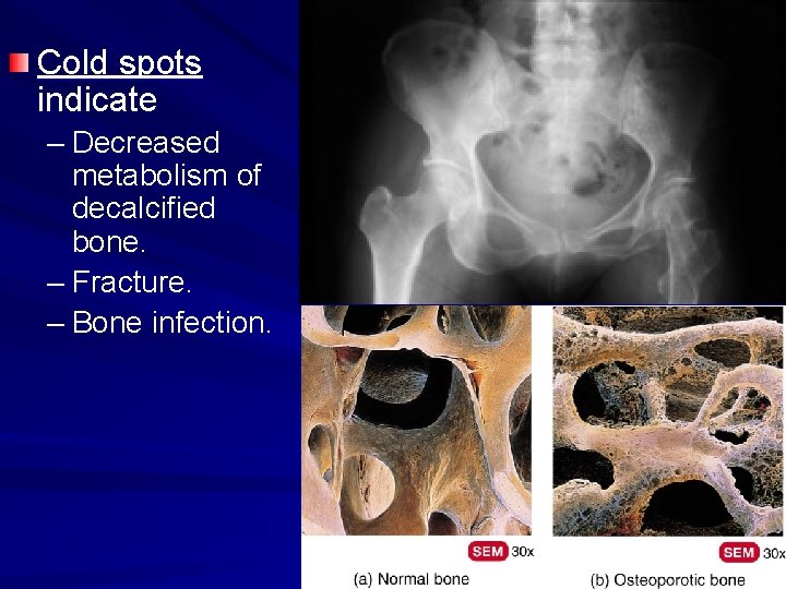 Cold spots indicate – Decreased metabolism of decalcified bone. – Fracture. – Bone infection.